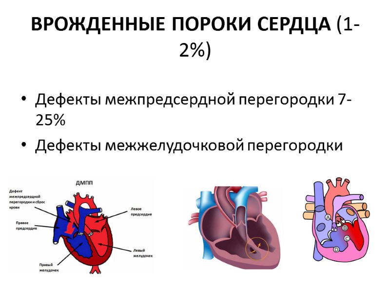 ВРОЖДЕННЫЕ ПОРОКИ СЕРДЦА (1-2%) Дефекты межпредсердной перегородки 7-25% Дефекты межжелудочковой перегородки